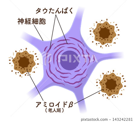 阿茲海默症患者的大腦:神經細胞、β-澱粉樣蛋白、tau蛋白(插圖) 阿茲海默症患者的大腦:神經細胞、β-澱粉樣蛋白、tau蛋白(插圖) 143242281