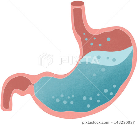 gastroesophageal reflux illustration 143250057
