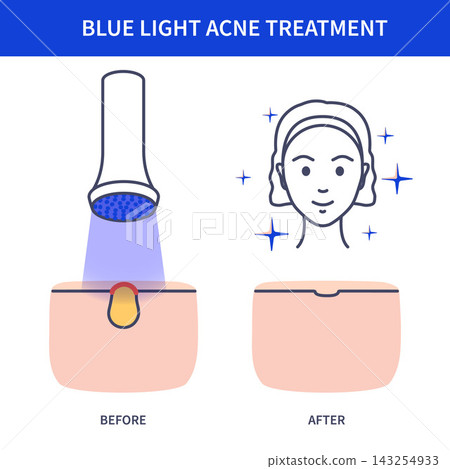 Blue Acne Face Chart Vector Illustration Blue Acne Face Chart Vector Illustration 143254933