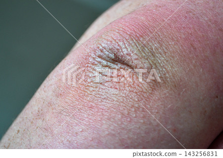 Close up dry flaky skin on elbow, caused by psoriasis. Close up dry flaky skin on elbow, caused by psoriasis. 143256831