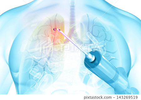 Human lungs with medicine syringe Human lungs with medicine syringe 143269519