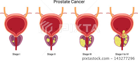 Prostate Cancer 143277296