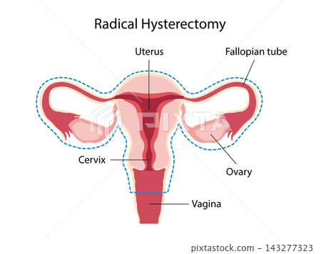 Radical Hysterectomy Radical Hysterectomy 143277323