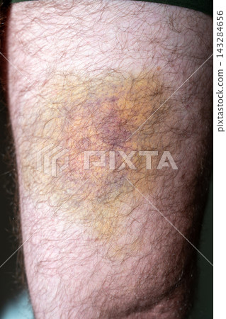Large hematoma bruise on human thigh Large hematoma bruise on human thigh 143284656