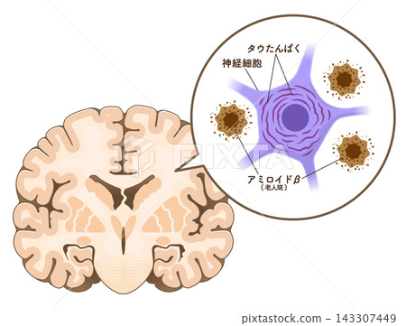 阿茲海默症患者的大腦:β-澱粉樣蛋白和tau蛋白 阿茲海默症患者的大腦:β-澱粉樣蛋白和tau蛋白 143307449