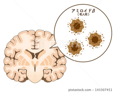 The brain of someone with Alzheimer's disease: Amyloid-beta and tau protein The brain of someone with Alzheimer's disease: Amyloid-beta and tau protein 143307451