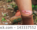 wounded leg skin after an outdoor accident. Concept of injury 143337552