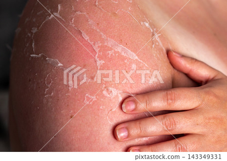 Close up of peeling skin on woman arms after sunburn. Redness and flaking indicate UV burn. Result of ignoring using SPF cream and safe sun exposure hours Close up of peeling skin on woman arms after sunburn. Redness and flaking indicate UV burn. Result of ignoring using SPF cream and safe sun exposure hours 143349331