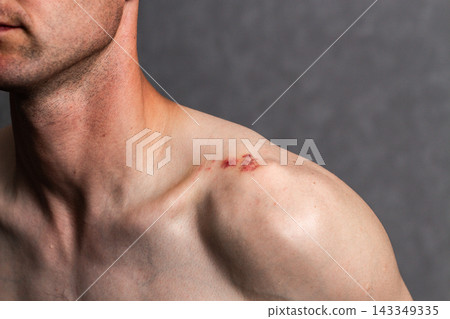 Close up of male shoulder with red bruise on it. Small wound caused by impact. Damaged skin on human body 143349335