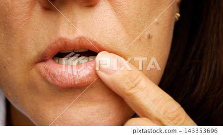 Woman applying ointment with a finger to a cold sore on her lip Woman applying ointment with a finger to a cold sore on her lip 143353696