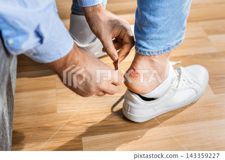 Man treating a painful heel blister on foot caused by shoe friction. Applying adhesive plaster for skin protection, sore wound care, foot discomfort relief, and healthcare therapy. Man treating a painful heel blister on foot caused by shoe friction. Applying adhesive plaster for skin protection, sore wound care, foot discomfort relief, and healthcare therapy. 143359227