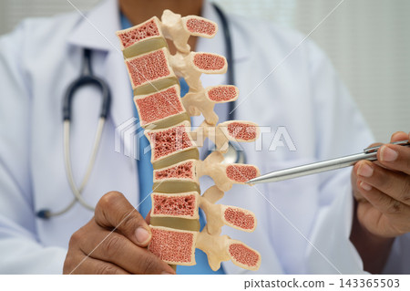 Doctor holding osteoporosis in back bone model for treatment medical in orthopedic department. Doctor holding osteoporosis in back bone model for treatment medical in orthopedic department. 143365503