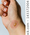 Detail of fluid filled blister from thermal burn on wrist. Medical skin damage and injury recovery concept	 143372004