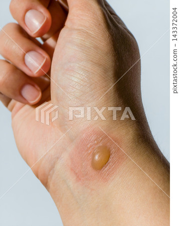 Detail of fluid filled blister from thermal burn on wrist. Medical skin damage and injury recovery concept Detail of fluid filled blister from thermal burn on wrist. Medical skin damage and injury recovery concept 143372004