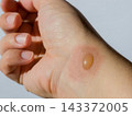 Second degree thermal burn with a fluid blister on the wrist of a human hand. Skin injury and dermatology care concept 143372005
