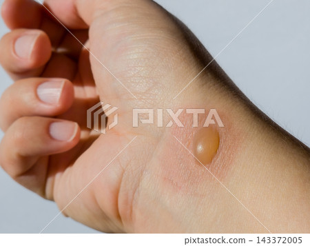 Second degree thermal burn with a fluid blister on the wrist of a human hand. Skin injury and dermatology care concept Second degree thermal burn with a fluid blister on the wrist of a human hand. Skin injury and dermatology care concept 143372005