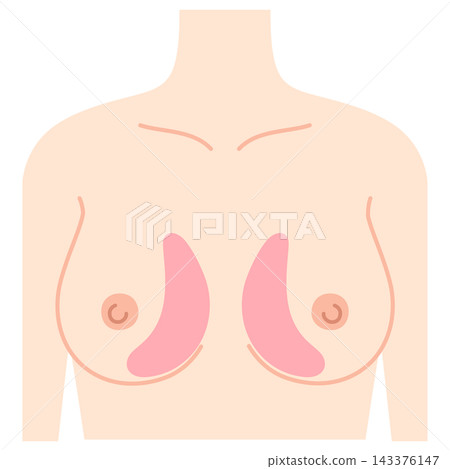Breast augmentation, breast design, hyaluronic acid injection sites Breast augmentation, breast design, hyaluronic acid injection sites 143376147