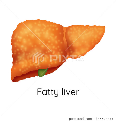 Fatty liver showing enlarged mottled orange liver lobe with small green gallbladder, with liver, fatty, organ, anatomy detail, showing hepatic, enlarged, mottled, orange context Fatty liver showing enlarged mottled orange liver lobe with small green gallbladder, with liver, fatty, organ, anatomy detail, showing hepatic, enlarged, mottled, orange context 143378253