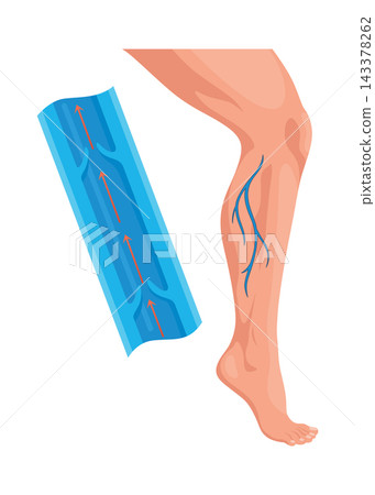 Leg without varicose veins. Blue blood vessel, not visible through the skin. Diagnosis and treatment of vascular diseases. Venous insufficiency is a medical condition Leg without varicose veins. Blue blood vessel, not visible through the skin. Diagnosis and treatment of vascular diseases. Venous insufficiency is a medical condition 143378262