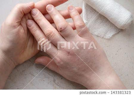 Traumatic ligament injury of ring finger with prominent joint lump and swelling after fall, showing painful movement and soft tissue damage during hand examination and rehabilitation recovery Traumatic ligament injury of ring finger with prominent joint lump and swelling after fall, showing painful movement and soft tissue damage during hand examination and rehabilitation recovery 143381323