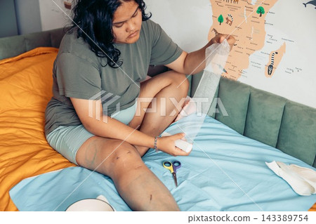 plus size young woman sitting on a bed and applying a gauze bandage to her injured leg at home. visible scars and bruising on the knee and thigh. home first aid, wound care, injury recovery plus size young woman sitting on a bed and applying a gauze bandage to her injured leg at home. visible scars and bruising on the knee and thigh. home first aid, wound care, injury recovery 143389754