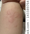 Hives ☆mar_lapin 143389764