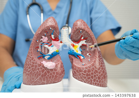Pneumonia, lung cancer, Asian doctor with human lung model. Pneumonia, lung cancer, Asian doctor with human lung model. 143397638