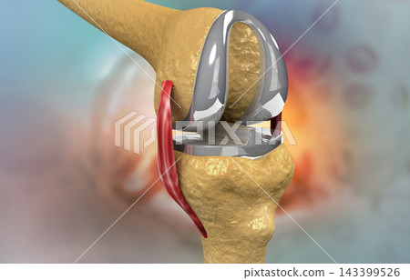 Steel knee cap on knee joint Steel knee cap on knee joint 143399526