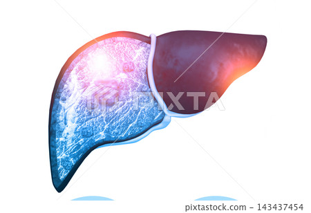 Diseased human liver Diseased human liver 143437454