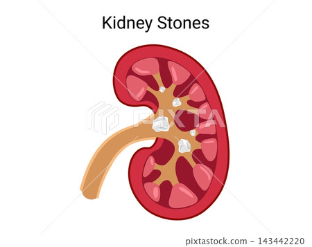Kidney Stones Kidney Stones 143442220