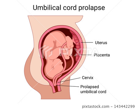 Prolapsed umbilical cord Prolapsed umbilical cord 143442299