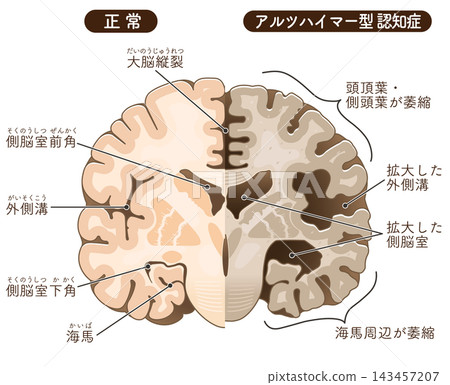 The brain of an Alzheimer's patient The brain of an Alzheimer's patient 143457207