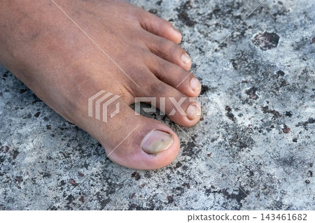 Woman foot displaying discolored and damaged big toenail condition outdoors. Fungal nail infection and dermatology healthcare view. Woman foot displaying discolored and damaged big toenail condition outdoors. Fungal nail infection and dermatology healthcare view. 143461682