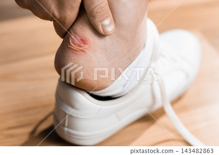 Man checking a painful blister on his heel caused by footwear friction. Close-up of sore foot, skin irritation, chafing wound, and shoe discomfort requiring medical first aid care. Man checking a painful blister on his heel caused by footwear friction. Close-up of sore foot, skin irritation, chafing wound, and shoe discomfort requiring medical first aid care. 143482863