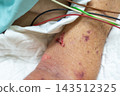 A close view of bruised skin shows purple marks small wound white dressing colored medical wires beside pale bedding green fabric visible skin texture around the affected area 143512325