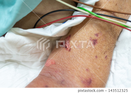 A close view of bruised skin shows purple marks small wound white dressing colored medical wires beside pale bedding green fabric visible skin texture around the affected area A close view of bruised skin shows purple marks small wound white dressing colored medical wires beside pale bedding green fabric visible skin texture around the affected area 143512325
