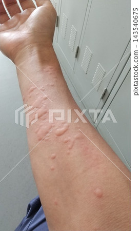 hives hives 143540675
