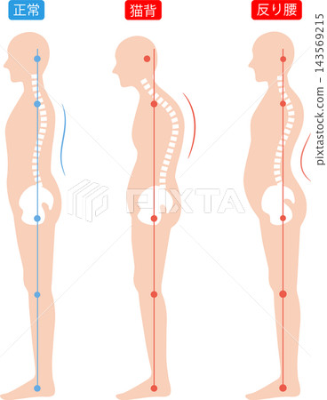 Rounded shoulders, swayback, and correct posture: the whole body, spine and pelvis Rounded shoulders, swayback, and correct posture: the whole body, spine and pelvis 143569215