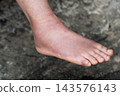 Swollen Foot After Cast Removal of Metatarsal Fracture 143576143