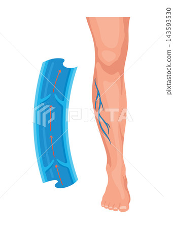 Leg without varicose veins. Blue blood vessel, not visible through the skin. Diagnosis and treatment of vascular diseases. Venous insufficiency is a medical condition Leg without varicose veins. Blue blood vessel, not visible through the skin. Diagnosis and treatment of vascular diseases. Venous insufficiency is a medical condition 143593530
