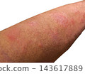 A human forearm shows a red rash and small bumps, isolated on a white background 143617889