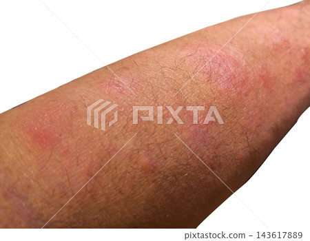 A human forearm shows a red rash and small bumps, isolated on a white background A human forearm shows a red rash and small bumps, isolated on a white background 143617889