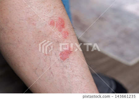 Close-up view of psoriasis patches on a human arm, featuring red, scaly lesions with visible hair and a blurred indoor background 143661235
