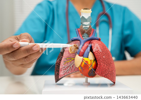 Pneumonia, lung cancer, Asian doctor holding human model. Pneumonia, lung cancer, Asian doctor holding human model. 143663440