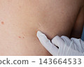 Gloved hand of a doctor points to a healed surgical scar on the back of a patient with visible moles. Postoperative follow-up after lung surgery in thoracic medicine and skin examination. 143664533