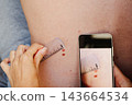 Woman places a measuring ruler next to a mole on her back and photographs the skin with a smartphone. Self-monitoring and mole mapping for early melanoma detection. 143664534