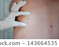 A gloved dermatologist examines moles and pigmented spots on the bare back of a patient during a skin check. Close-up for melanoma screening, early skin cancer detection and preventive dermatology. 143664535