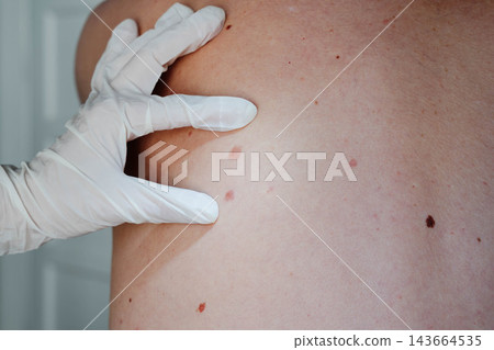 A gloved dermatologist examines moles and pigmented spots on the bare back of a patient during a skin check. Close-up for melanoma screening, early skin cancer detection and preventive dermatology. A gloved dermatologist examines moles and pigmented spots on the bare back of a patient during a skin check. Close-up for melanoma screening, early skin cancer detection and preventive dermatology. 143664535