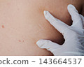 Gloved hands of a doctor stretch the skin on a bare back to reveal a healed surgical scar and scattered moles. Dermatology checkup and follow-up after lung surgery in a clinic. 143664537