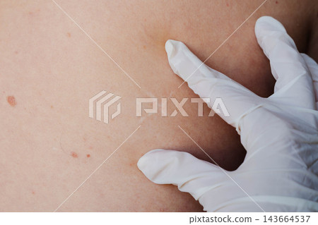 Gloved hands of a doctor stretch the skin on a bare back to reveal a healed surgical scar and scattered moles. Dermatology checkup and follow-up after lung surgery in a clinic. Gloved hands of a doctor stretch the skin on a bare back to reveal a healed surgical scar and scattered moles. Dermatology checkup and follow-up after lung surgery in a clinic. 143664537